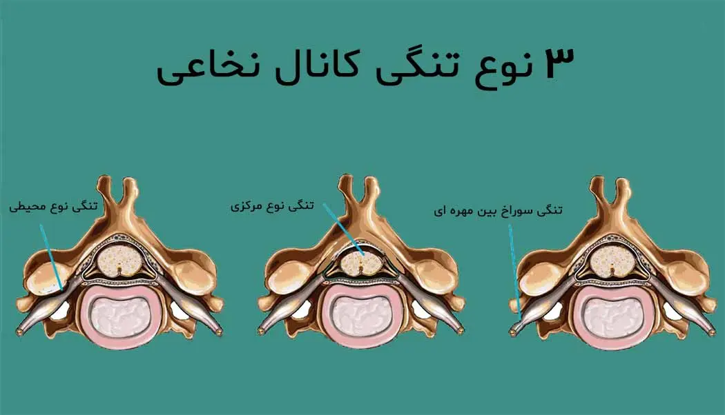 کانال نخاعی