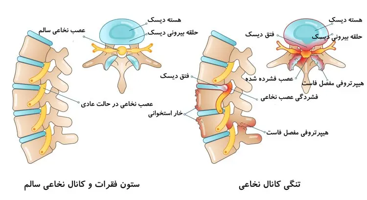 کانال نخاعی