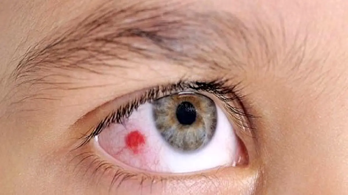 سرطان چشم ، بیماری که بیشتردر کمین چشم رنگی هاست!
