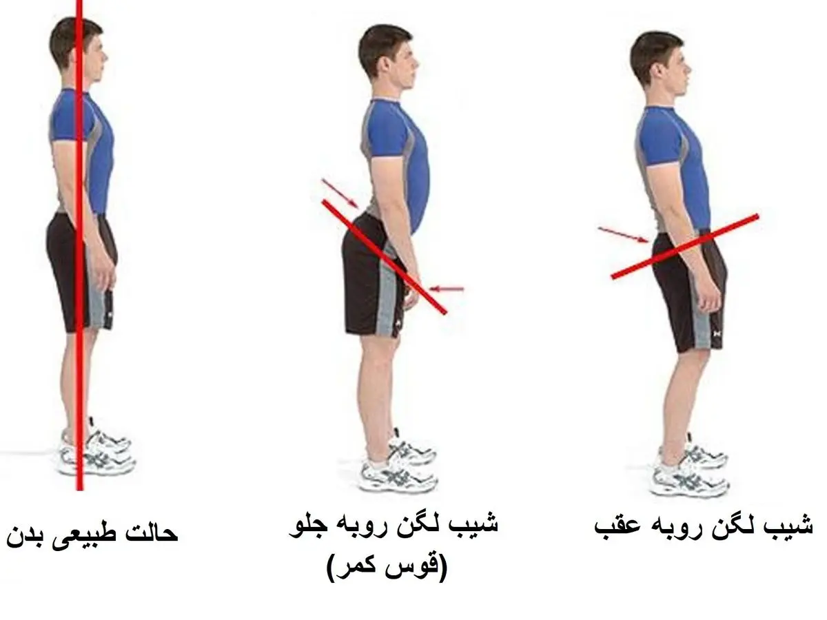 گودی کمر را به صورت تخصصی تر مورد بررسی قرار بدهید و بعد به پزشک مراجعه کنید!!!