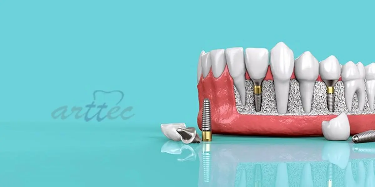 مزایای ایمپلنت دندان چیست؟