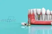 مزایای ایمپلنت دندان چیست؟