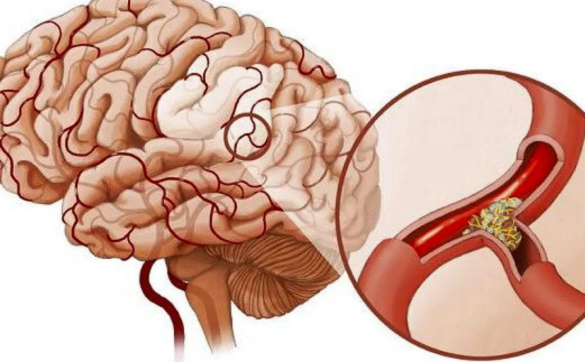 لطفا جدی بگیرید: این علائم به سکته مغزی منتهی می شود